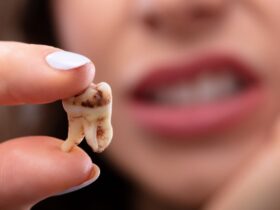 Arti Mimpi Gigi Tanggal atau Copot: Apa Benar Pertanda Buruk?