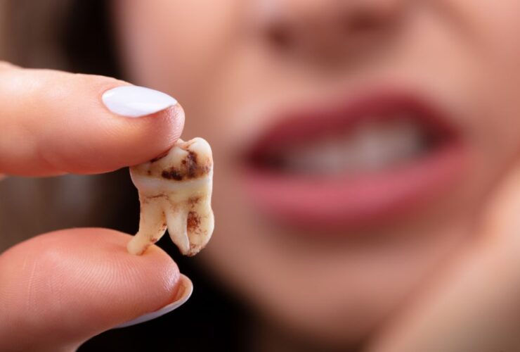 Arti Mimpi Gigi Tanggal atau Copot: Apa Benar Pertanda Buruk?