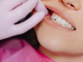 Cara Memutihkan Gigi yang Aman dan Efektif