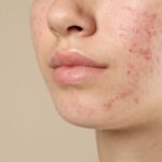 Mengatasi Jerawat pada Kulit Sensitif: Panduan Aman tanpa Memperparah