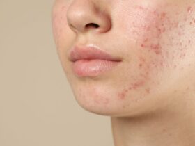 Mengatasi Jerawat pada Kulit Sensitif: Panduan Aman tanpa Memperparah