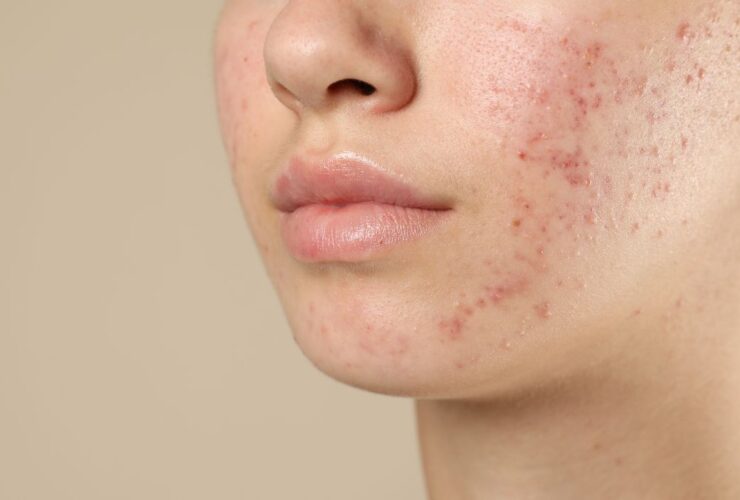 Mengatasi Jerawat pada Kulit Sensitif: Panduan Aman tanpa Memperparah