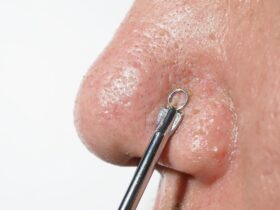 Cara Mengatasi Komedo: Apakah Facial Wajib?