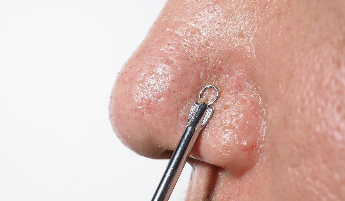 Cara Mengatasi Komedo: Apakah Facial Wajib?