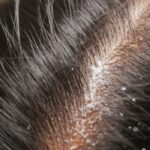 Cara Efektif Mengatasi Ketombe dan Mengembalikan Kesehatan Rambut