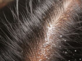 Cara Efektif Mengatasi Ketombe dan Mengembalikan Kesehatan Rambut