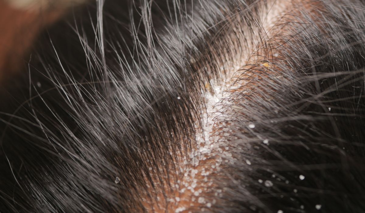 Cara Efektif Mengatasi Ketombe dan Mengembalikan Kesehatan Rambut