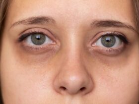 Mata Panda: Lebih Dari Sekadar Kurang Tidur. Ini Penyebab Sebenarnya