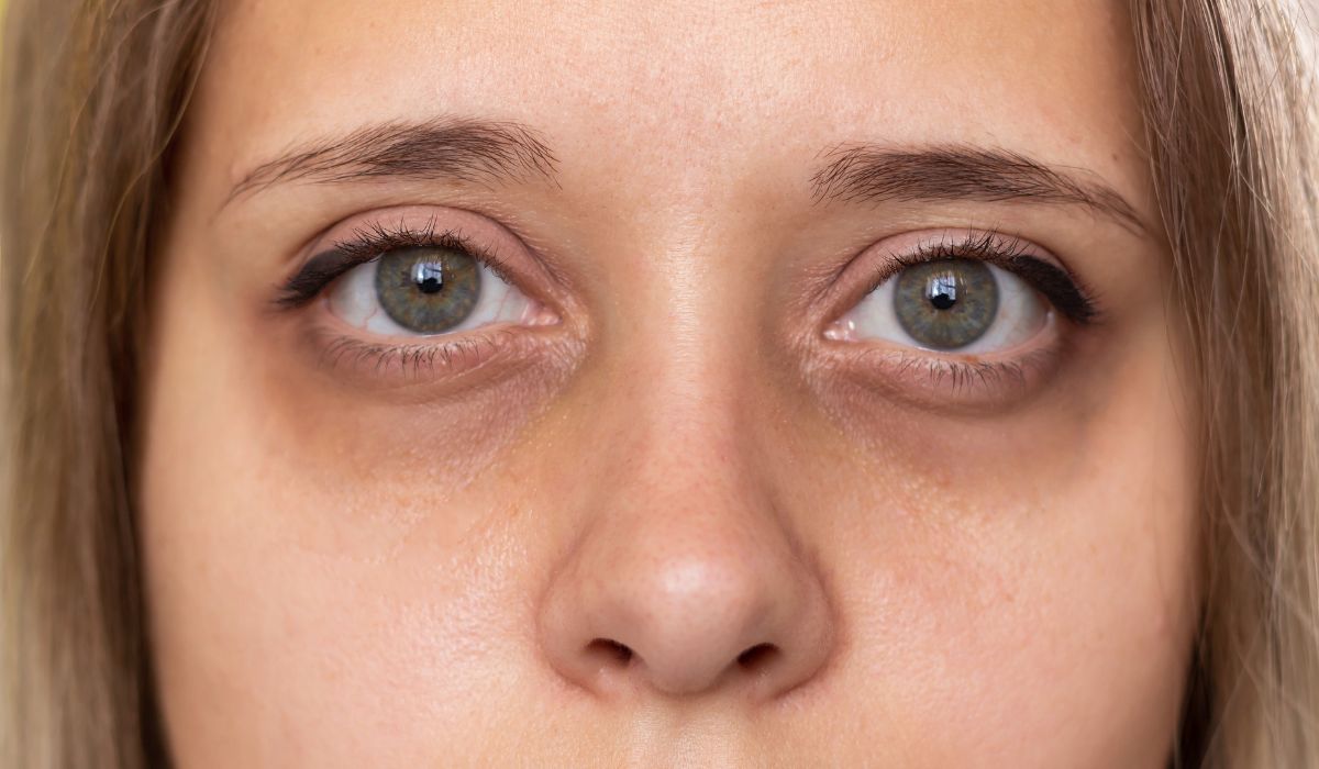 Mata Panda: Lebih Dari Sekadar Kurang Tidur. Ini Penyebab Sebenarnya